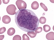 Chronic Myelomonocytic Leukemia - 2.