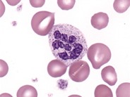 Chronic Myelomonocytic Leukemia - 3.