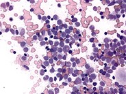 Chronic Myelomonocytic Leukemia - 4.