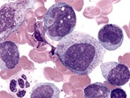 Chronic Myelomonocytic Leukemia - 3.