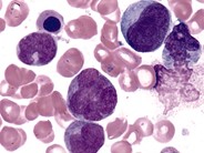 Chronic Myelomonocytic Leukemia - 6.