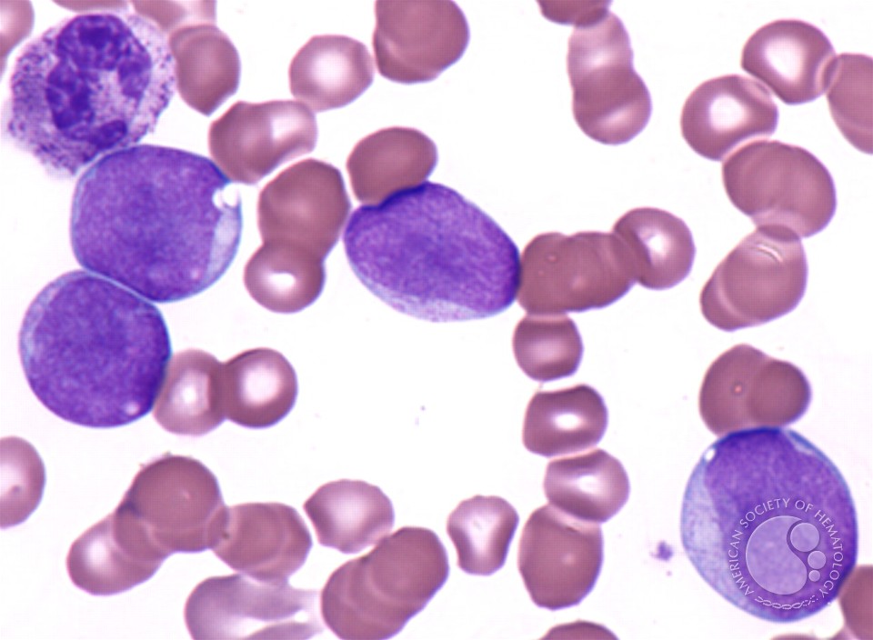 Acute Myelomonocytic Leukemia - 3.