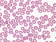 Immune Thrombocytopenic Purpura - 1.
