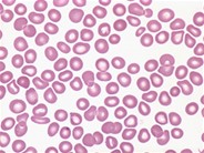 thrombotic thrombocytopenic purpura smear