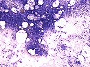 Immune Thrombocytopenic Purpura - 2.