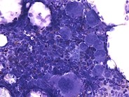 Immune Thrombocytopenic Purpura - 3.