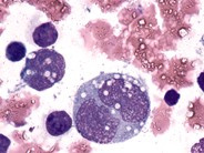 Rhabdomyosarcoma - 1.