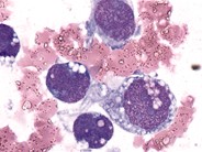 Rhabdomyosarcoma - 3.