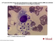 Disseminated cryptococcosis in bone marrow