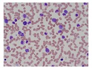 Atypical Chronic Myeloid Leukemia