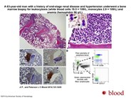 Plasmacytoid dendritic cells in chronic myelomonocytic leukemia