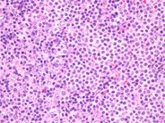 Marginal Zone Lymphoma - 1.