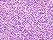 Marginal Zone Lymphoma - 2.