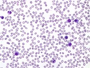 Plasma Cell Leukemia - 1.