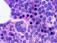 Lymphoblastic Lymphoma - 1.