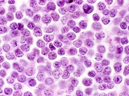 Lymphoblastic Lymphoma - 3.