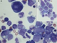 Cytospin preparation of AML in pleural fluid