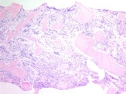 Neuroblastoma Ganglion Cell Differentiation Following Chemotherapy - 1.