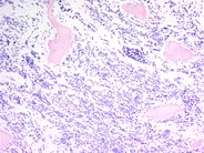 Neuroblastoma Ganglion Cell Differentiation Following Chemotherapy - 2.