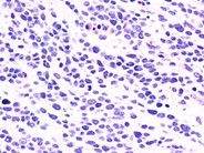 Neuroblastoma Ganglion Cell Differentiation Following Chemotherapy - 3.