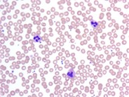 Platelet satellitism due to EDTA  Anticoagulant - 7.