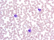 Platelet satellitism due to EDTA Anticoagulant - 7.