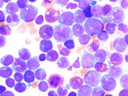 Chemotherapy-Related AML, M4e - 5.