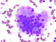 Marrow Changes in Renal Osteodystrophy - 2.