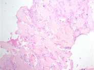 Marrow Changes in Renal Osteodystrophy - 3.