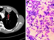 Nodular sclerosis Hodgkin lymphoma with classic Reed-Sternberg cells