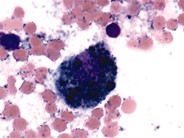 Metastatic Melanoma - 2.