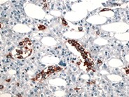 Intravascular Large B-Cell Lymphoma - 3.