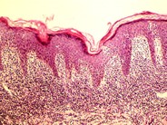 Mycosis Fungoides - 1.