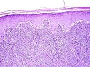 Precursor B-Cell Lymphoblastic Lymphoma - 1.