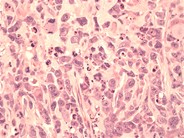 Anaplastic Large Cell Lymphoma - 2.