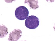 Precursor B-Lymphoblastic Leukemia - 1.