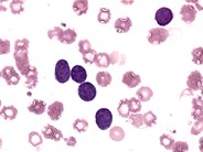Precursor B-Lymphoblastic Leukemia - 2.