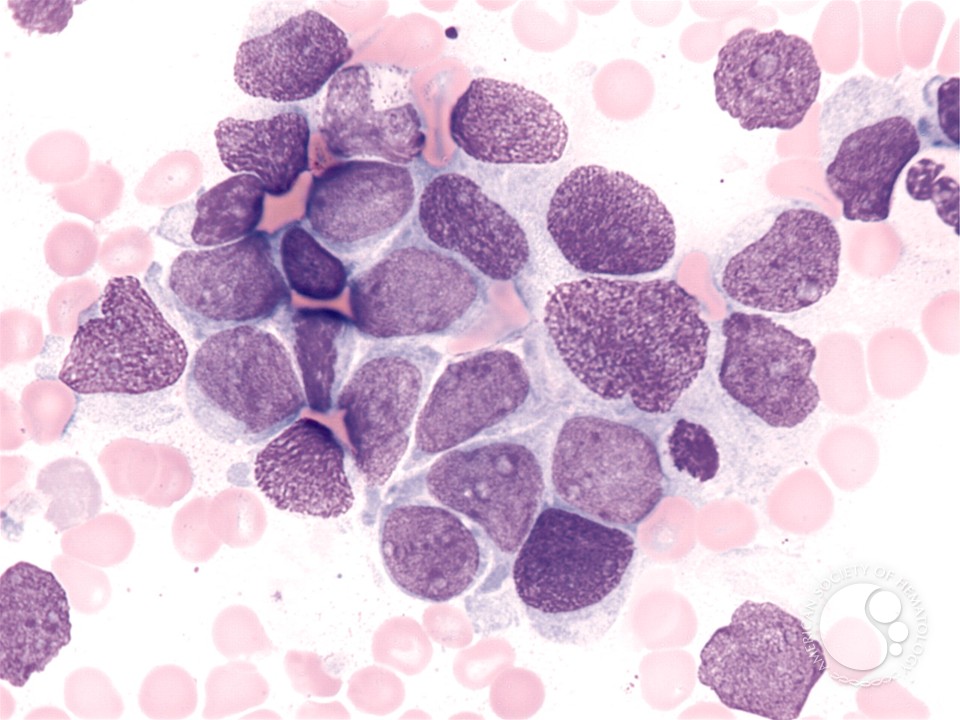 Retinoblastoma - 1.