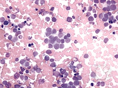 Retinoblastoma - 2.