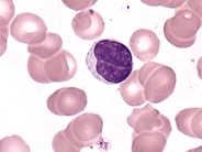 Clefted Lymphocyte - 1.