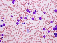 Transient myeloproliferative disorder