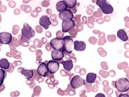 Pediatric Pre-B ALL - 1.