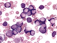 Pediatric Pre-B ALL - 2.