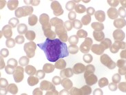 Infectious Mononucleosis - 3.