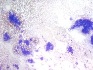 Metastatic Prostatic Carcinoma - 2.