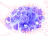 Metastatic Prostatic Carcinoma - 4.