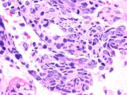 Metastatic Prostatic Carcinoma - 7.