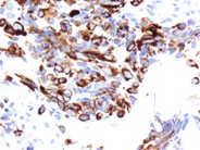 Metastatic Prostatic Carcinoma - 9.