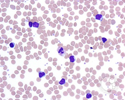 Diagnosis of bacteremia on a blood smear