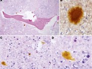 Hematoidin
